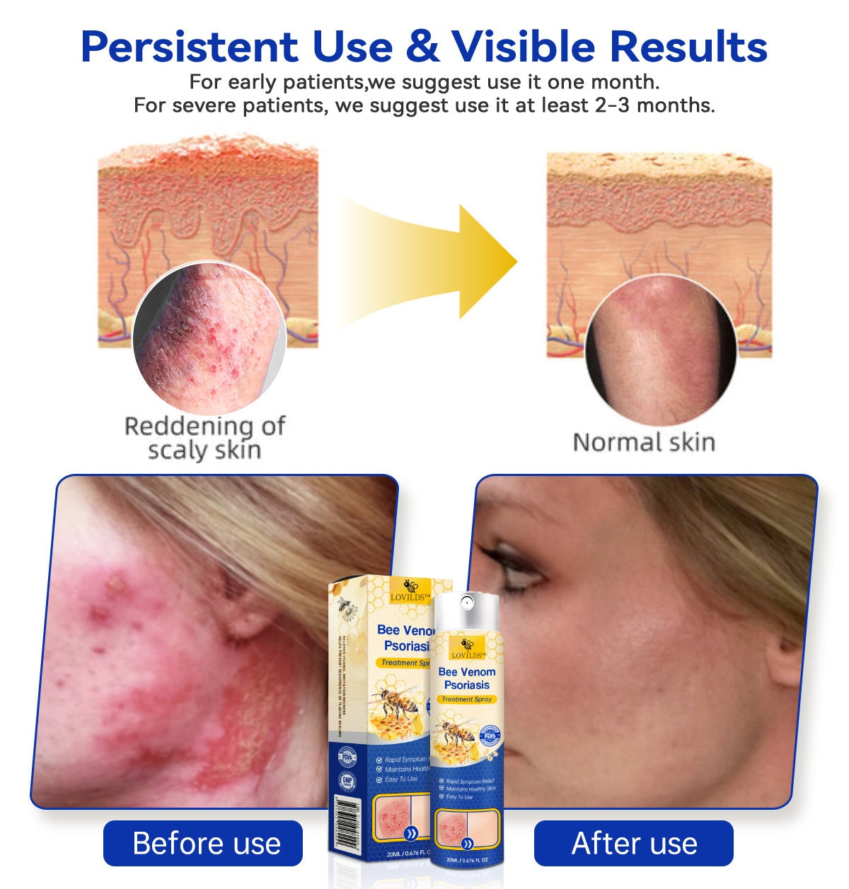 š„LOVILDSā¢PsoriaHeal psoriasis Spray pro(š„ 60% off bundle purchase last day limited š„)