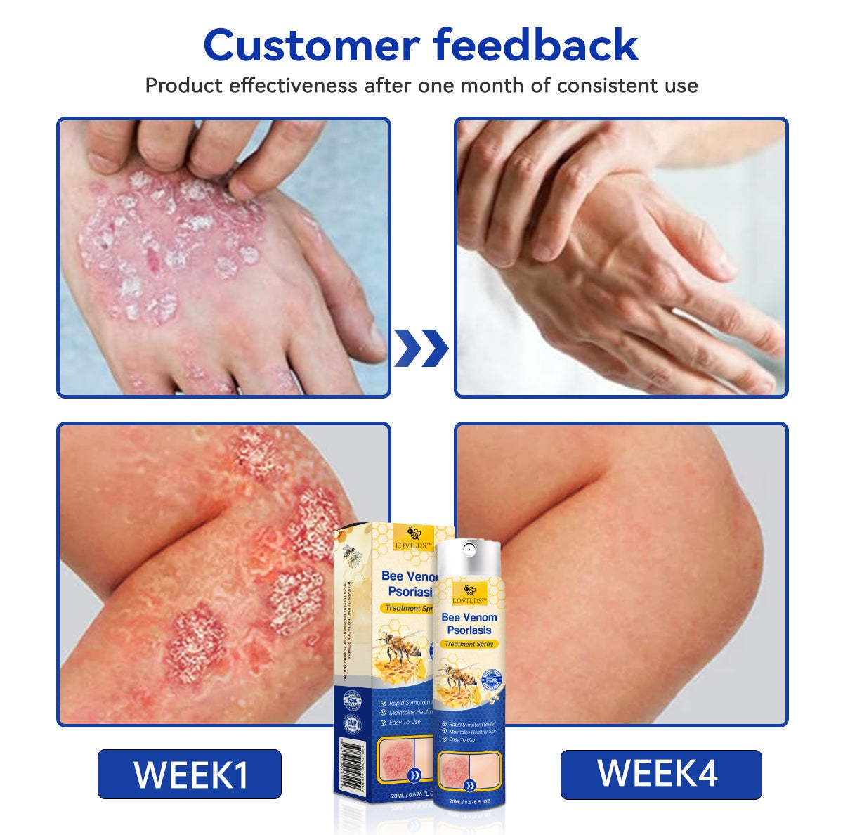 š„LOVILDSā¢PsoriaHeal psoriasis Spray pro(š„ 60% off bundle purchase last day limited š„)