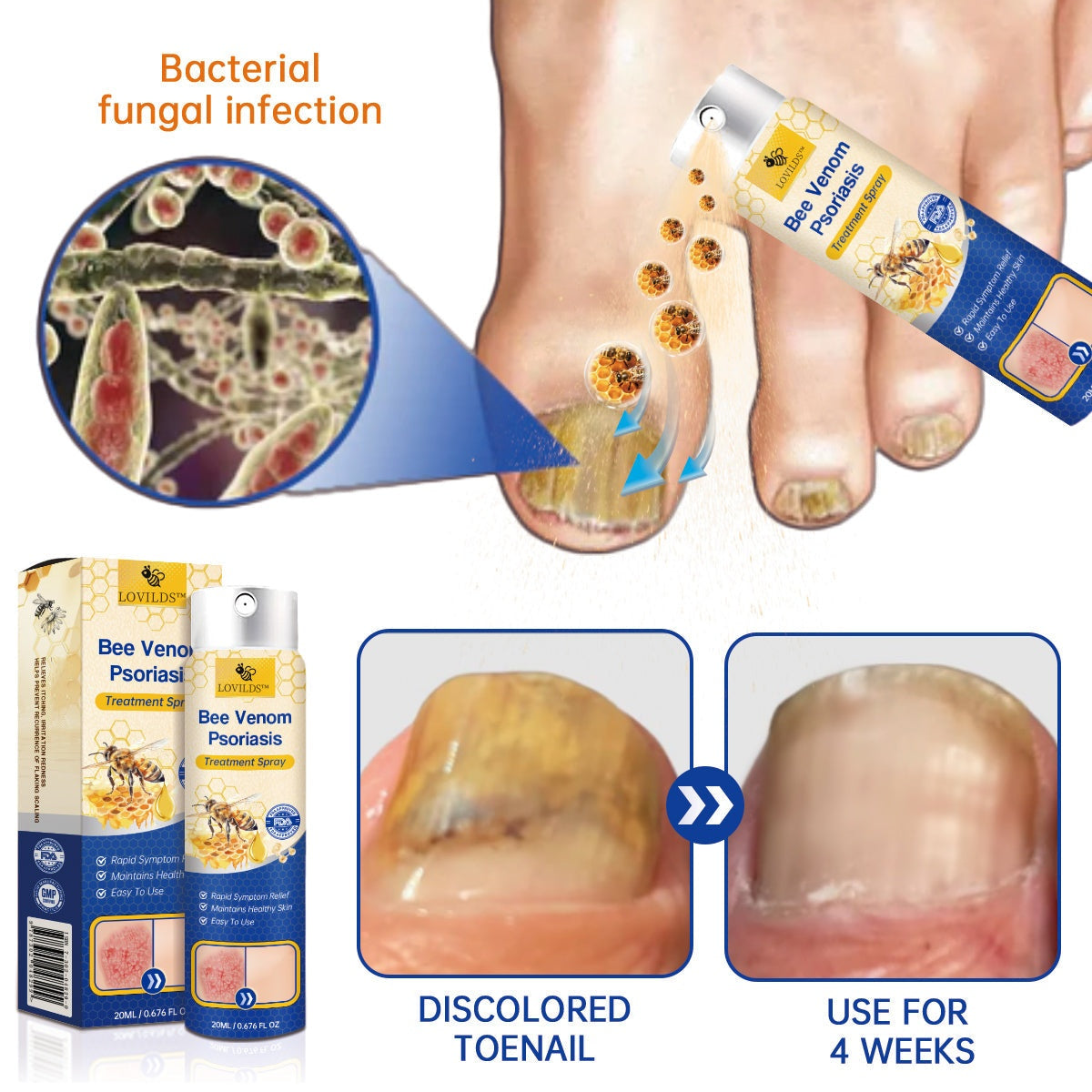 š„LOVILDSā¢PsoriaHeal psoriasis Spray pro(š„ 60% off bundle purchase last day limited š„)