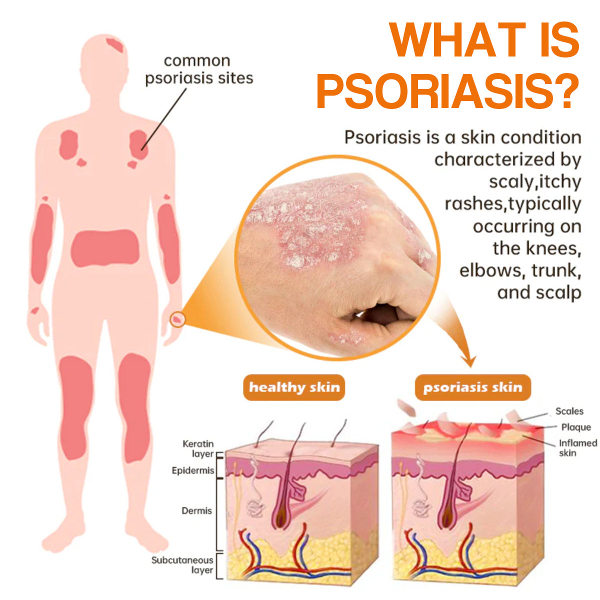 š„LOVILDSā¢PsoriaHeal psoriasis Spray pro(š„ 60% off bundle purchase last day limited š„)