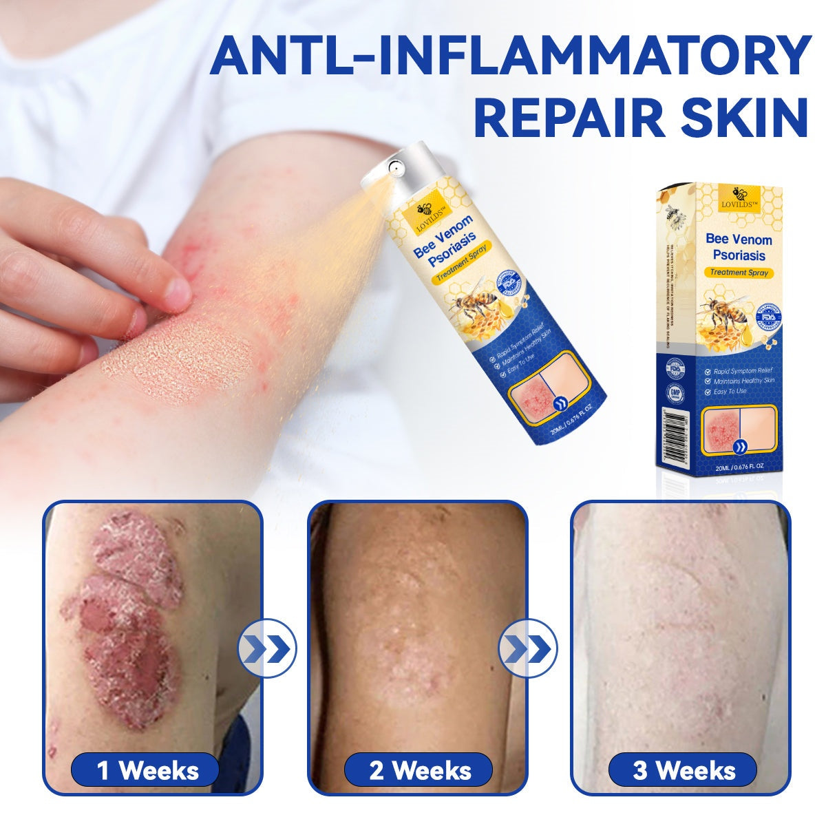 š„LOVILDSā¢PsoriaHeal psoriasis Spray pro(š„ 60% off bundle purchase last day limited š„)