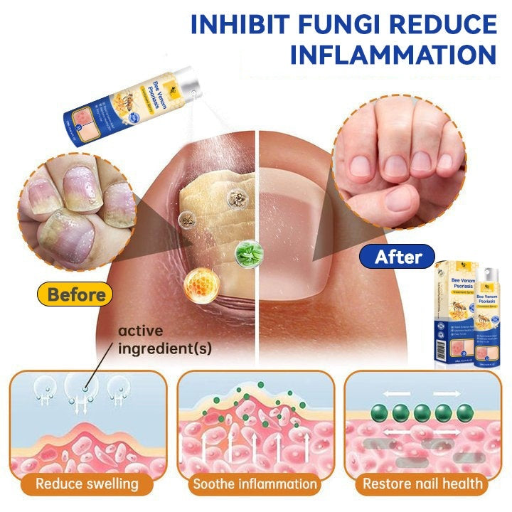 š„LOVILDSā¢PsoriaHeal psoriasis Spray pro(š„ 60% off bundle purchase last day limited š„)
