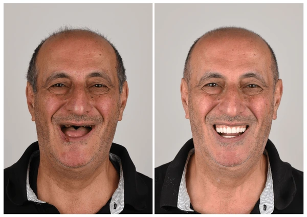 ✅ FDA Certified ✅ Recommended by U.S. Dentists | So comfortable, you’ll forget you’re even wearing dentures!