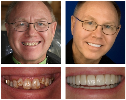 ✅ FDA Certified ✅ Recommended by U.S. Dentists | So comfortable, you’ll forget you’re even wearing dentures!