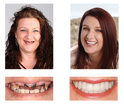 ✅ FDA Certified ✅ Recommended by U.S. Dentists | So comfortable, you’ll forget you’re even wearing dentures!