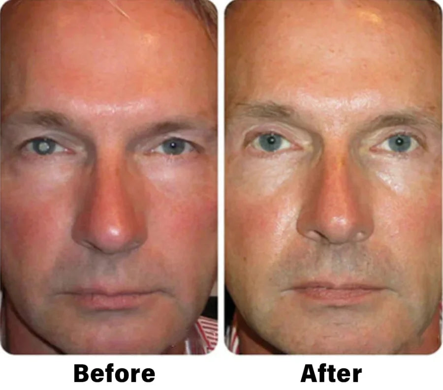 NESLEMY™ Nano Vision Repair Eye Serum ✅FDA Approved(Suitable for presbyopia, dry eye syndrome, glaucoma, and cataracts)