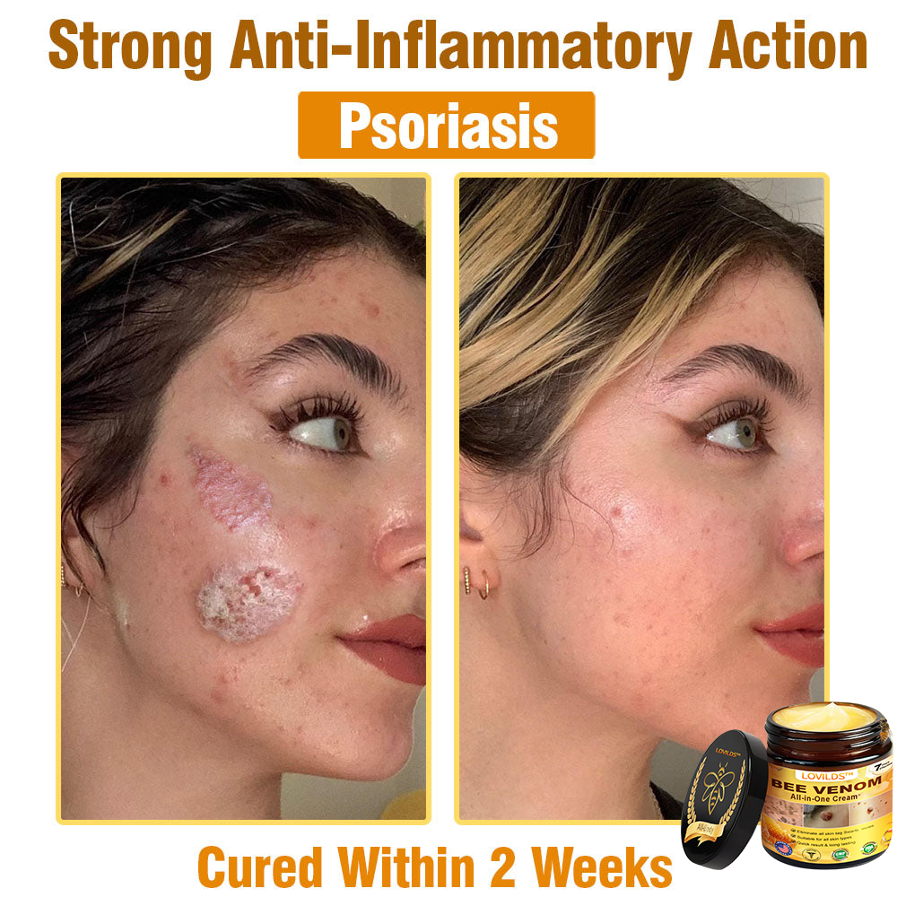 LOVILDS™ Bee Venom All-in-One Cream 👩⚕️US Dermatologist Approved
