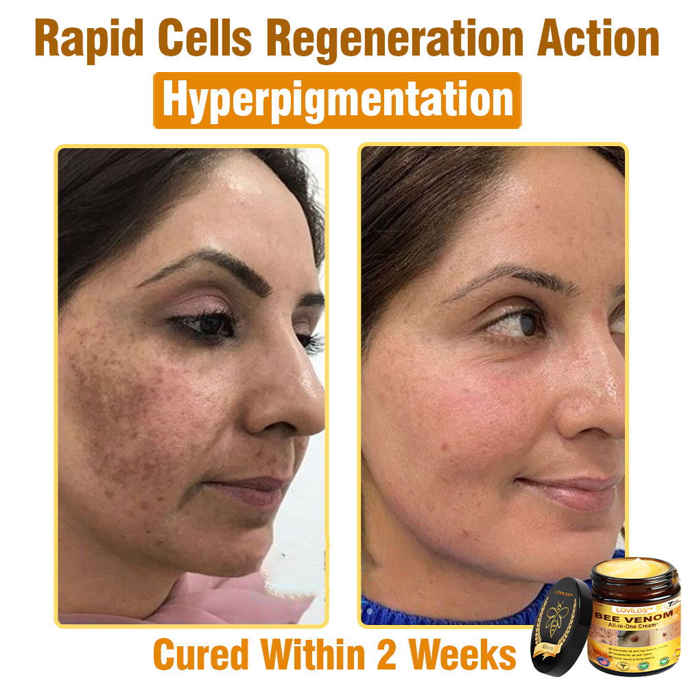 LOVILDS™ Bee Venom All-in-One Cream 👩⚕️US Dermatologist Approved