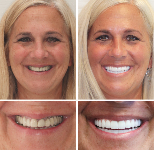 ✅ FDA Certified ✅ Recommended by U.S. Dentists | So comfortable, you’ll forget you’re even wearing dentures!