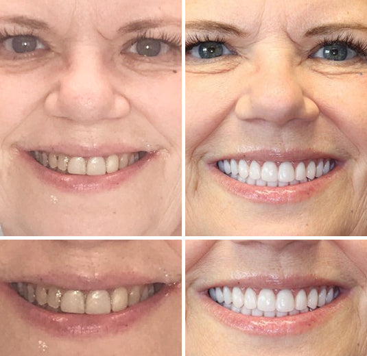 ✅ FDA Certified ✅ Recommended by U.S. Dentists | So comfortable, you’ll forget you’re even wearing dentures!