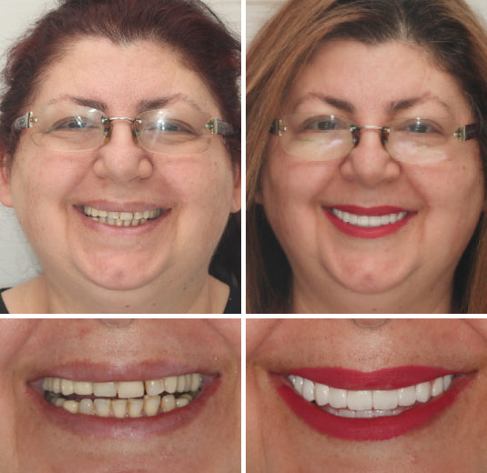 ✅ FDA Certified ✅ Recommended by U.S. Dentists | So comfortable, you’ll forget you’re even wearing dentures!