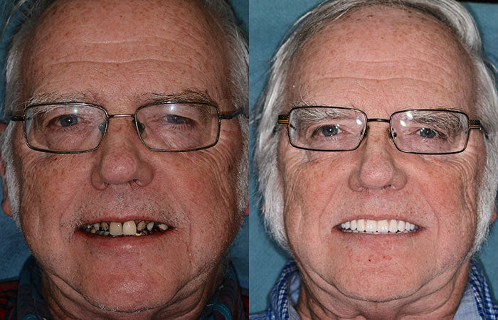 ✅ FDA Certified ✅ Recommended by U.S. Dentists | So comfortable, you’ll forget you’re even wearing dentures!
