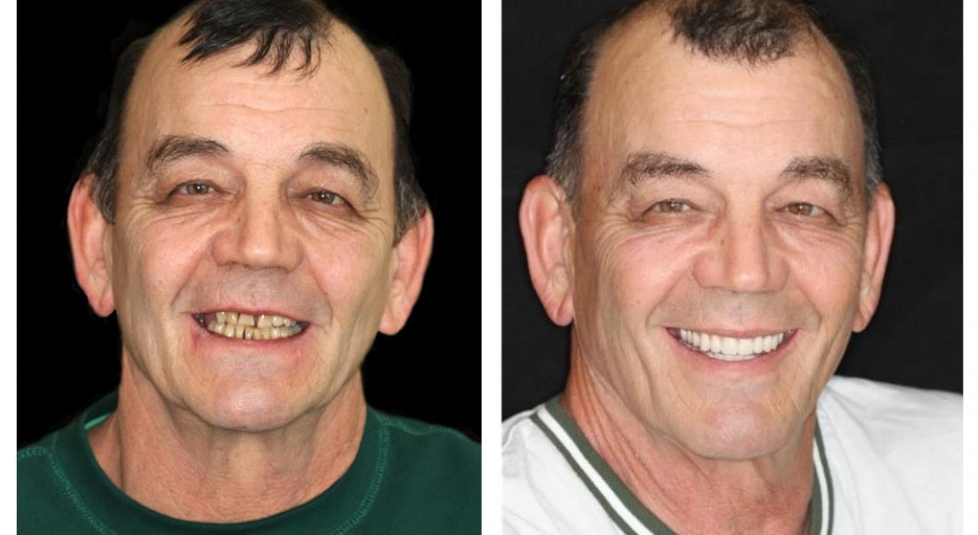 ✅ FDA Certified ✅ Recommended by U.S. Dentists | So comfortable, you’ll forget you’re even wearing dentures!