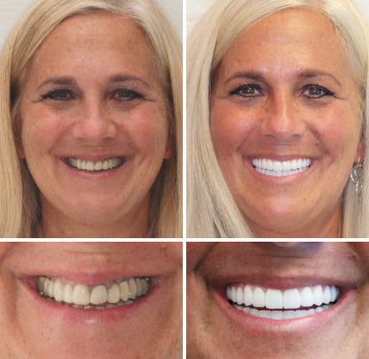 ✅ FDA Certified ✅ Recommended by U.S. Dentists | So comfortable, you’ll forget you’re even wearing dentures!