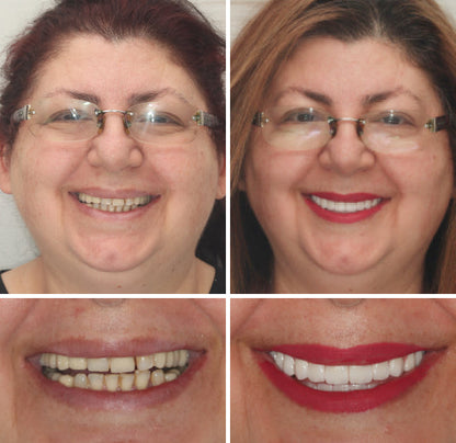 ✅ FDA Certified ✅ Recommended by U.S. Dentists | So comfortable, you’ll forget you’re even wearing dentures!