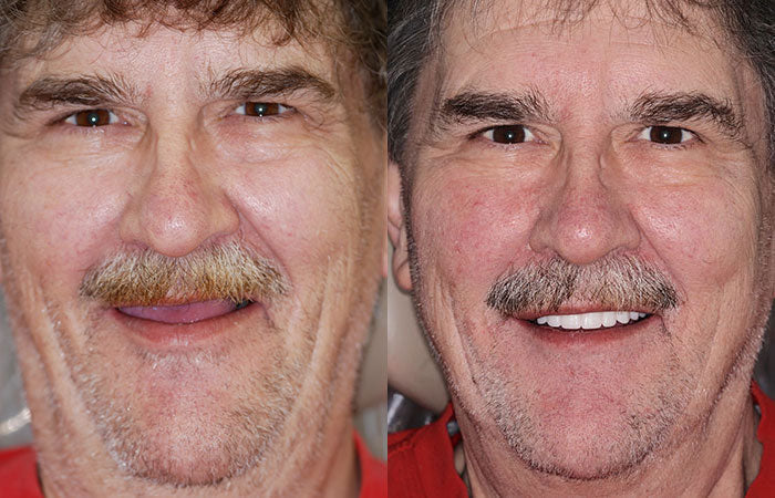 ✅ FDA Certified ✅ Recommended by U.S. Dentists | So comfortable, you’ll forget you’re even wearing dentures!
