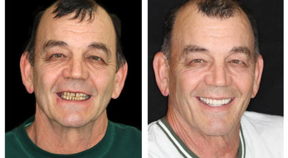 ✅ FDA Certified ✅ Recommended by U.S. Dentists | So comfortable, you’ll forget you’re even wearing dentures!